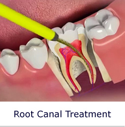 Root Canal Treatment